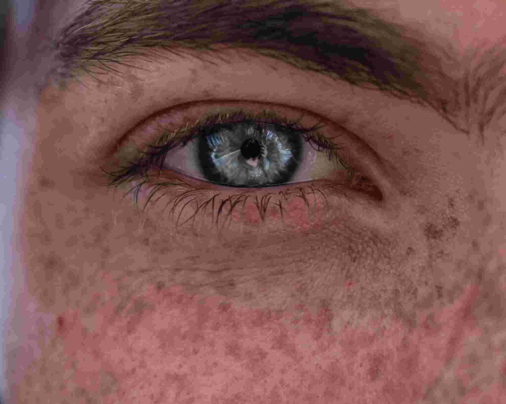 hyperpigmented skin