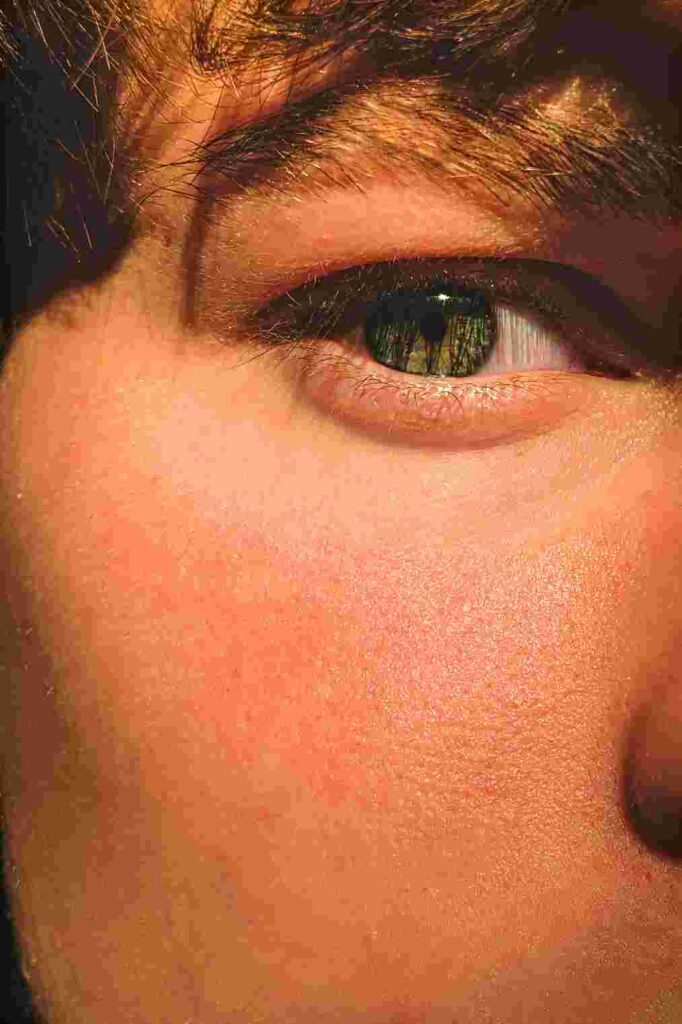 Dry Skin